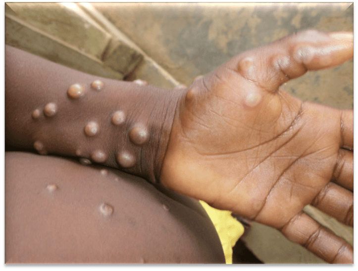 Morocco reports first-ever case of Mpox amid current outbreaks