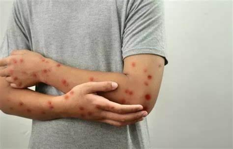 India Reports 1st Mpox Case from Fast-Spreading Clade 1B strain
