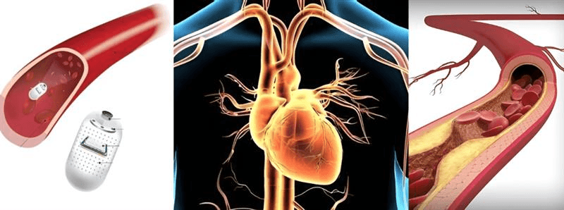 Nanotech Breakthrough Gives a New Ray of Hope for Atherosclerosis, the Deadly Heart Disease